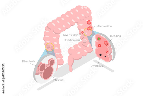 3D Isometric Flat  Conceptual Illustration of Diverticulosis And Diverticulitis, Medical Structure and Location photo