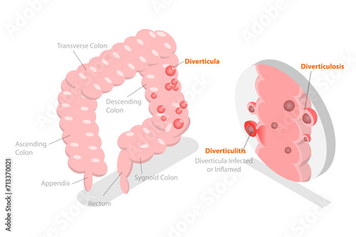 3D Isometric Flat  Conceptual Illustration of Diverticulitis, Medical Sructure and Location photo