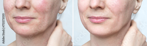 Woman with problem skin before after treatment. Healthy skin and cosmetic care. photo