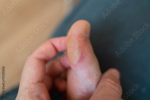 Close-up of a soft callus on a foot of a woman, sport shoes problem, corn on the leg. blister on the feet 