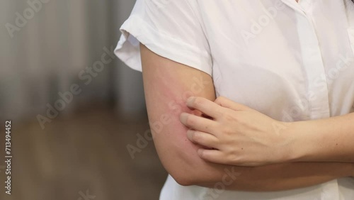 young Caucasian woman suffering from red rash and itching on her arm caused by an allergy, leading to the need to scratch the skin. This emphasizes the importance of skin health care and photo