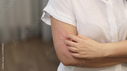 young Caucasian woman suffering from red rash and itching on her arm caused by an allergy, leading to the need to scratch the skin. This emphasizes the importance of skin health care and