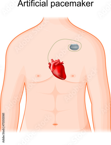 Artificial cardiac pacemaker. Human heart