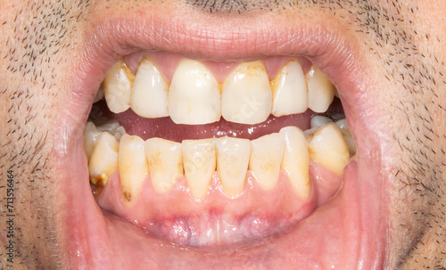 Close-up front view examination of a man mouth open with yellowish teeth colored spots because of smoking and bad hygiene, resin composite restorations. Beard hair and lower lip retracted. 