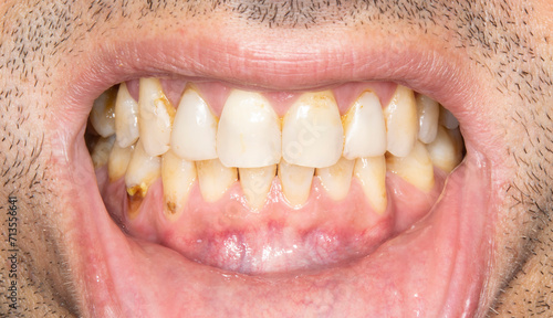 Close-up front view examination of a man mouth open with yellowish biting teeth colored spots because of smoking and bad hygiene, resin composite restorations. Beard hair and lower lip retracted. 