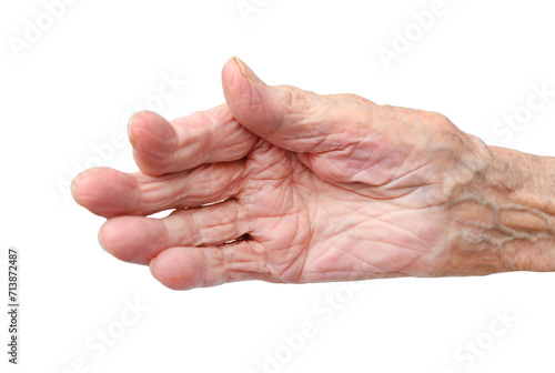 Rheumatoid polyarthritis of the hand of a 95 year old woman isolated on a white background.