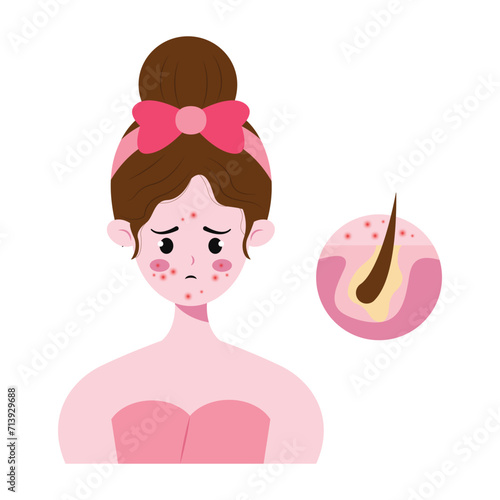 vector illustration of oily and acne prone skin problems