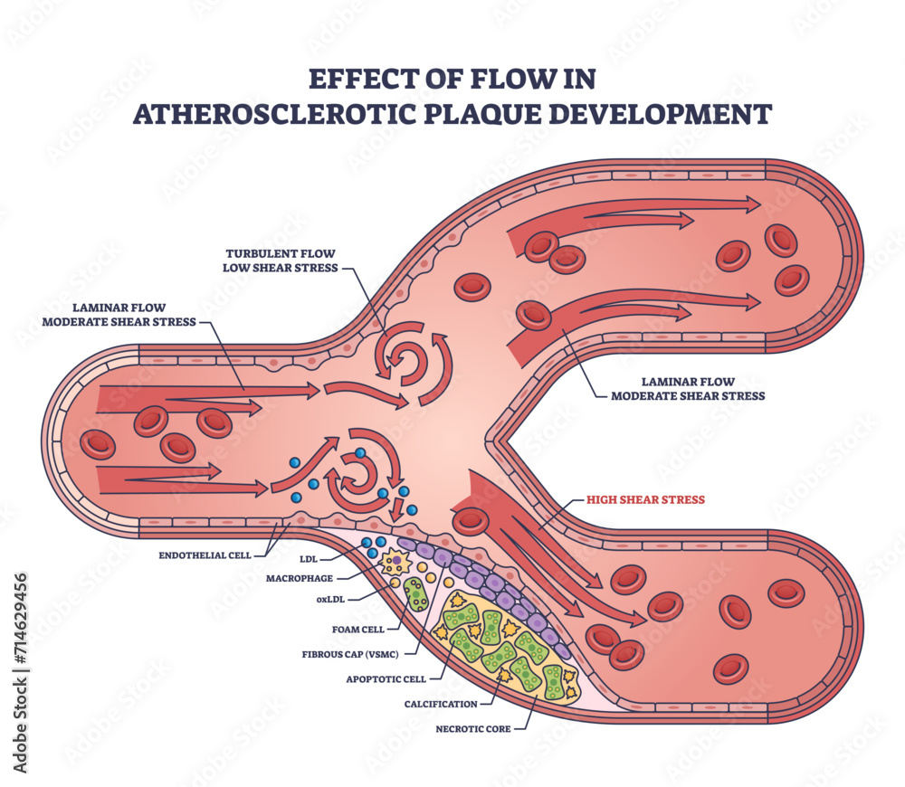 Effect of flow in atherosclerotic plaque development outline diagram ...