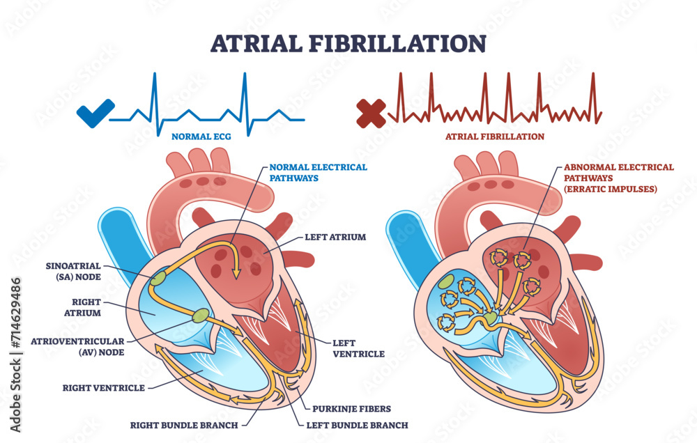 Atrial fibrillation as abnormal heart beat frequency disease outline diagram, transparent background. Labeled educational scheme with cardiovascular condition and heart structure illustration. - obrazy, fototapety, plakaty 