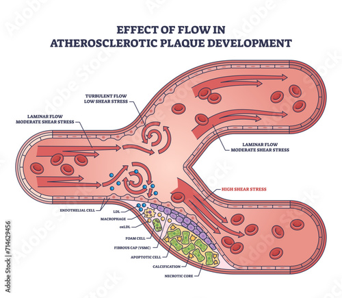 Effect of flow in atherosclerotic plaque development outline diagram, transparent background. Labeled educational cardiovascular condition of artery thickening or hardening issue illustration.