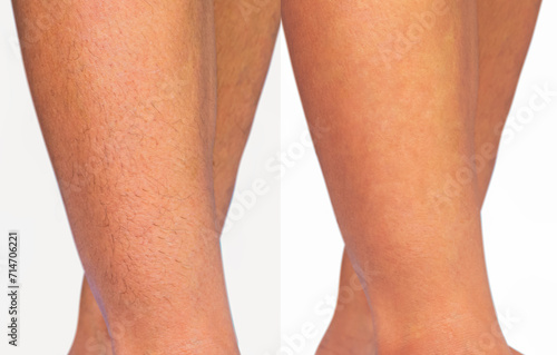 Image compare woman legs with hairs and hairless. Result before and after leg hairs removal, skin care and beauty concept. photo