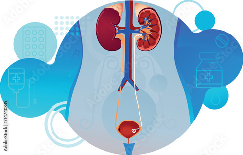 urinary system - an ureteral stent placed after kidney kidney stone removal