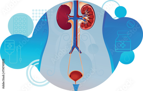 urinary system - kidney stones before the removal intervention