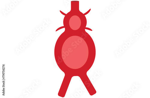 abdominal aortic aneurysm,heart aorta attack, aortic arch bulge open,vein clots stent stroke Marfan root left graft, hernia vessel pain High blood kidney damage Turner,red,pink,purple