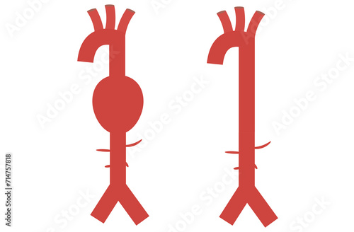 abdominal aortic aneurysm,heart aorta attack, aortic arch bulge open,vein clots stent stroke Marfan root left graft, hernia vessel pain High blood kidney damage Turner,red,pink,purple