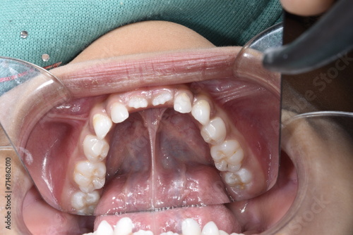 Lower mandibular arch occlusal indirect mirror view of a child dentition. Healthy gingival gum, tongue lifted with voluminous lingual frenum, cheek and lip retracted ,teeth aligned and no decay. photo