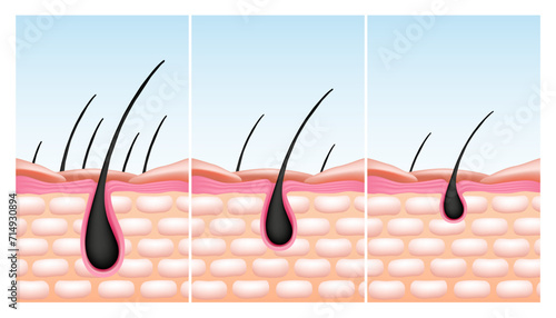 Scalp skin. Hair root reduce. Bulb or follicle fall. Baldness and growth structure. Nutrition drops treatment. Grow process. Epidermis and dermis microscopic diagram. Vector infographics