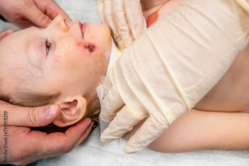 medical procedure dressing a boy with a first-degree burn from boiling water on his face, neck and chest