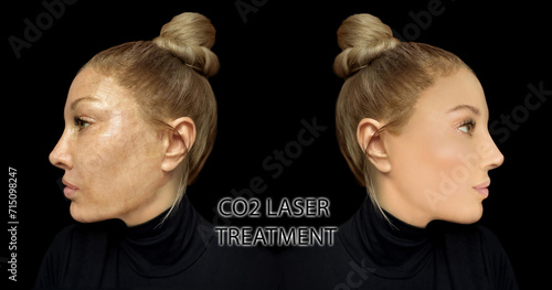 CO2 laser treatment ,Cosmetic Laser Dermatology  photo