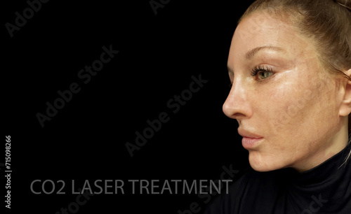 CO2 laser treatment ,Cosmetic Laser Dermatology  photo