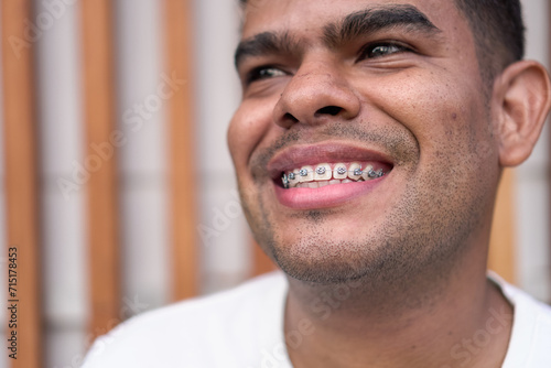 Canvas Print Close-Up of a Joyful Man with Dental Braces