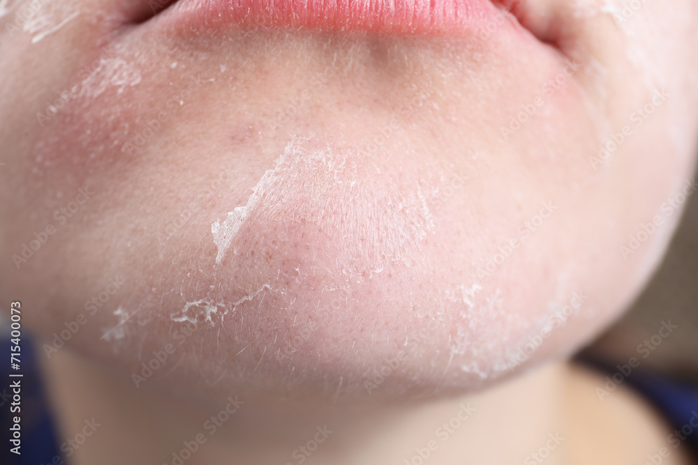 Fototapeta premium Woman with dry skin on face, closeup