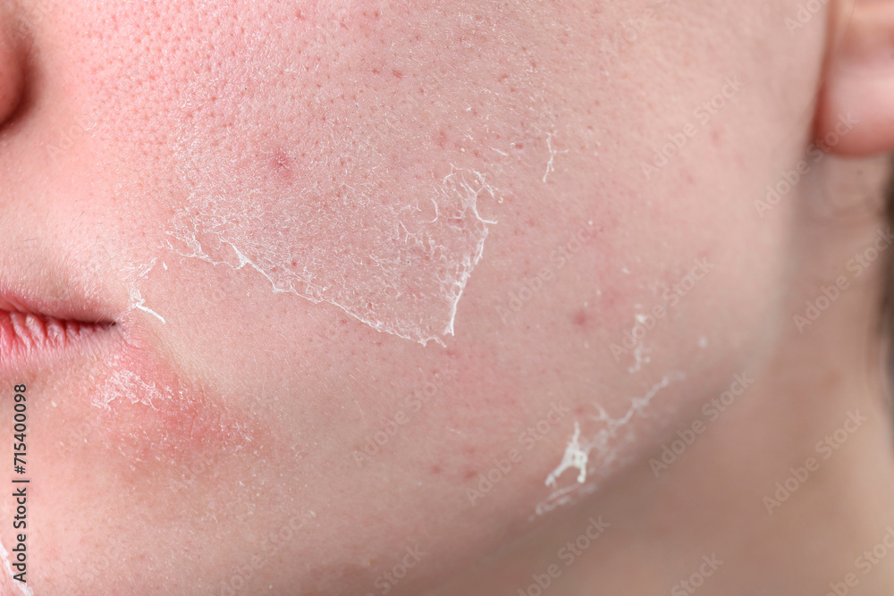 Fototapeta premium Woman with dry skin on face, closeup