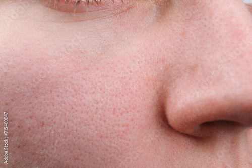 Woman with dry skin on face, closeup