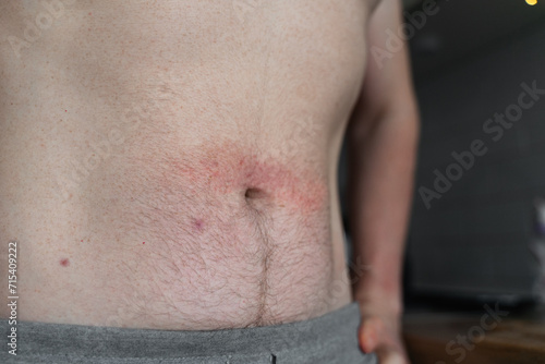 Close-up of man's body belly at home in kitchen with dermatitis rush and red irritation on the skin. photo