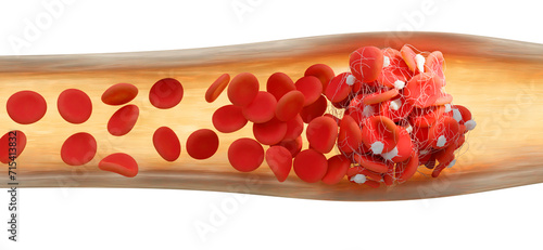 Blood clot, illustration