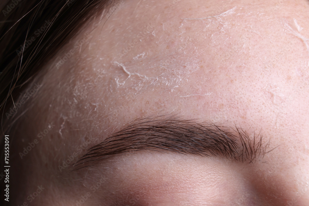 Woman with dry skin on forehead, macro view Woman with dry skin on forehead, macro view