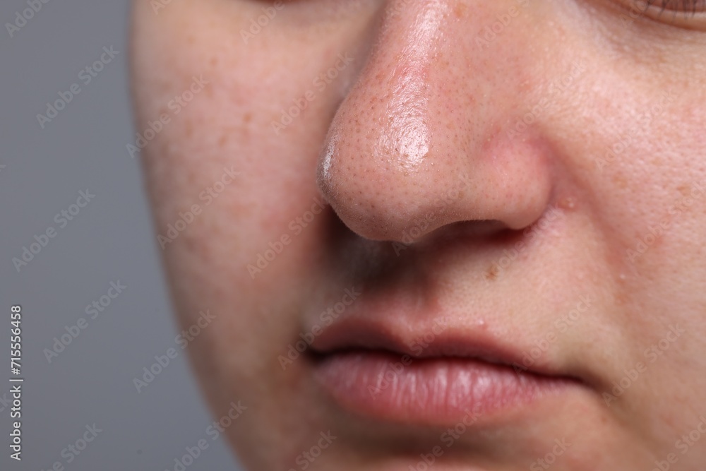 Obraz premium Closeup view of woman with comedones on her nose against grey background