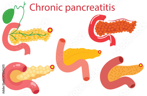 chronic pancreatitis,Pancreas disease logo, chronic pancreatitis. Medical appointment, examination and treatment in clinic. Pain and inflammation in human internal organs. Anatomical examination ,five