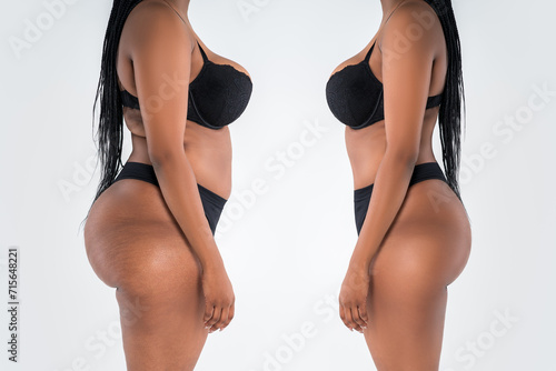 Tummy tuck, fat body before and after weight loss and liposuction on gray background, black African woman, plastic surgery concept photo