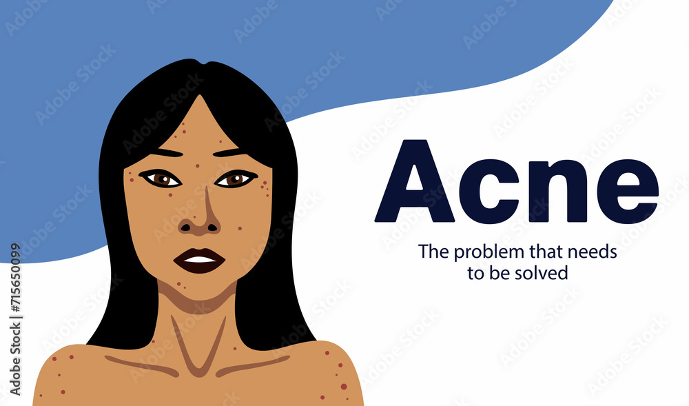 Banner about acne with young Asian woman minimalistic illustration naked to shoulders