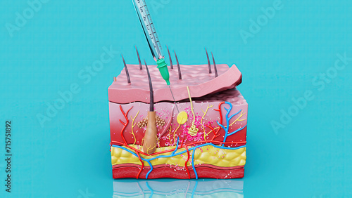 Abstract illustration of a subcutaneous injection photo