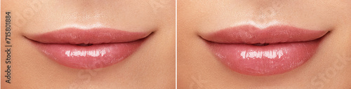 Female lips correction before and after comparison. Hyaluronic acid injection. Beauty lip treatment procedure.