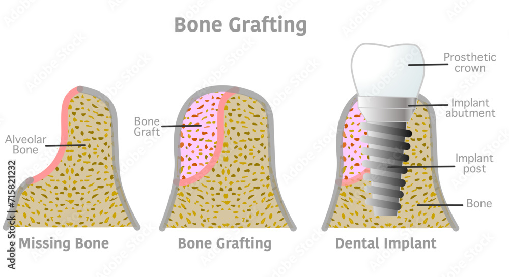 Bone grafting implant steps anatomy, teeth structure. Dental, tooth diagram. Bone titanium screw post, prosthetic crown, abutment, gum. Medical, periodontal. Vector illustration - obrazy, fototapety, plakaty 