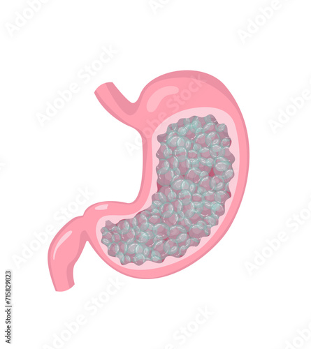 Stomach with gas and bloating feeling. Human internal organ disorder pathology. Vector illustration