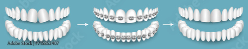 Dental braces before and after result vector illustration photo