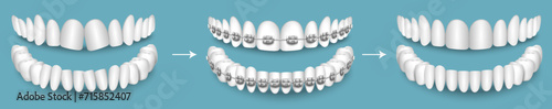 Dental braces before and after result vector illustration