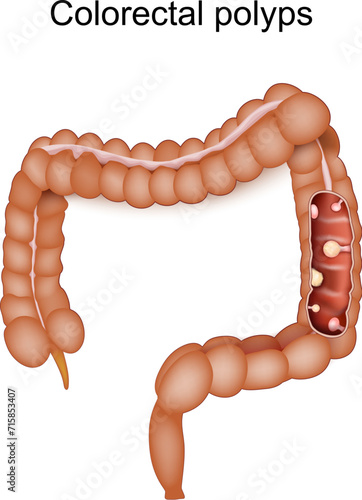 Colorectal polyps and Colon cancer.