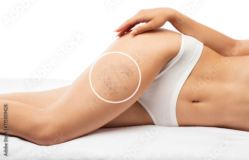 The woman shows the dilation of small blood vessels of the skin on the leg. Medical inspection and treatment of Telangiectasia. Phlebeurysm. photo