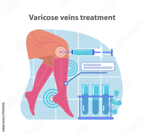 Specialized varicose veins treatment. A medical illustration depicting the advanced procedure for vein therapy. Flat vector illustration.