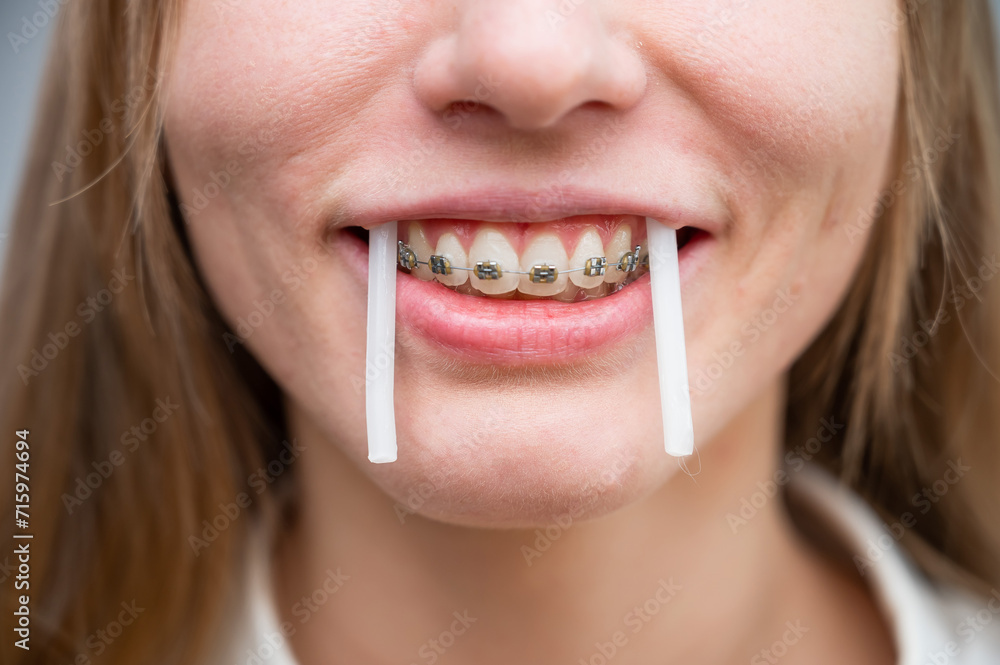 Naklejka premium Close-up portrait of a woman with braces using special orthodontic wax. Girl fooling around pretending to be a walrus.