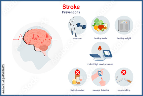 Medical illustration, educational vector illustration in flat style of prevention of stroke, exercise, limited alcohol, eating healthy foods, stop smoking, manage diabetes, control blood pressure.