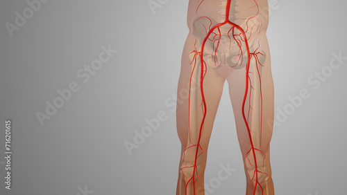 Peripheral artery bypass surgery medical animation