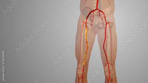 Peripheral artery bypass surgery medical animation photo