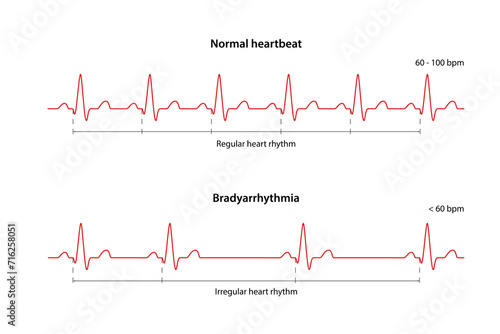Diagram of normal rhythm and Bradyarrhythmia for a human heart. Heart cardiogram. Vector illustration in flat style isolated on white background photo