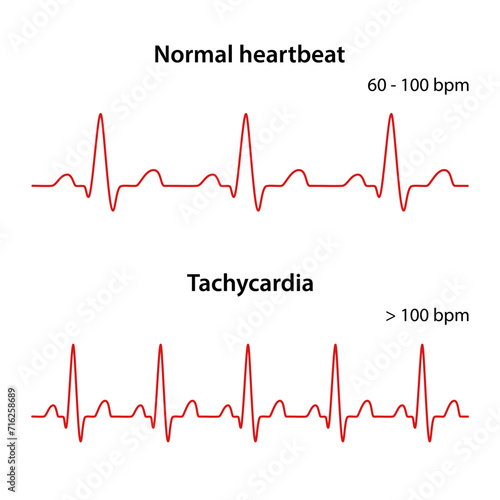 Diagram of normal rhythm and Tachycardia for a human heart. Heart cardiogram. Vector illustration in flat style isolated on white background